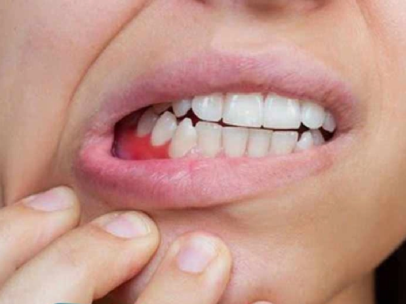 روش‌های درمان تحلیل لثه