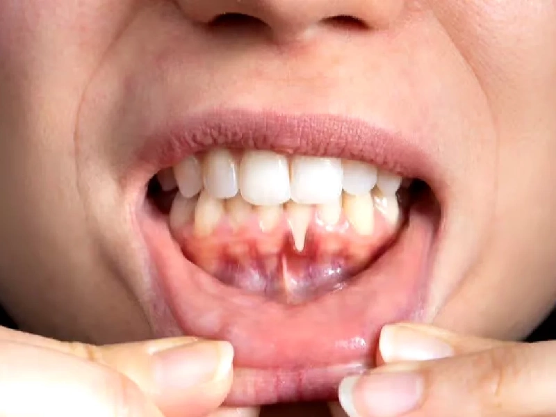 علائم تحلیل لثه